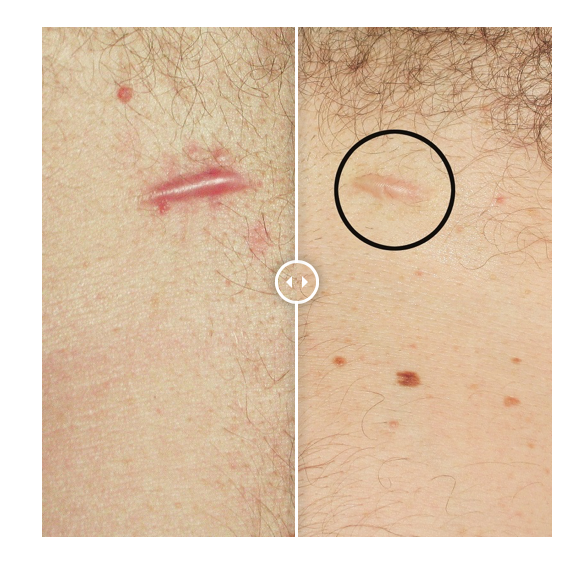 Strataderm Scar Therapy Cream 50g
